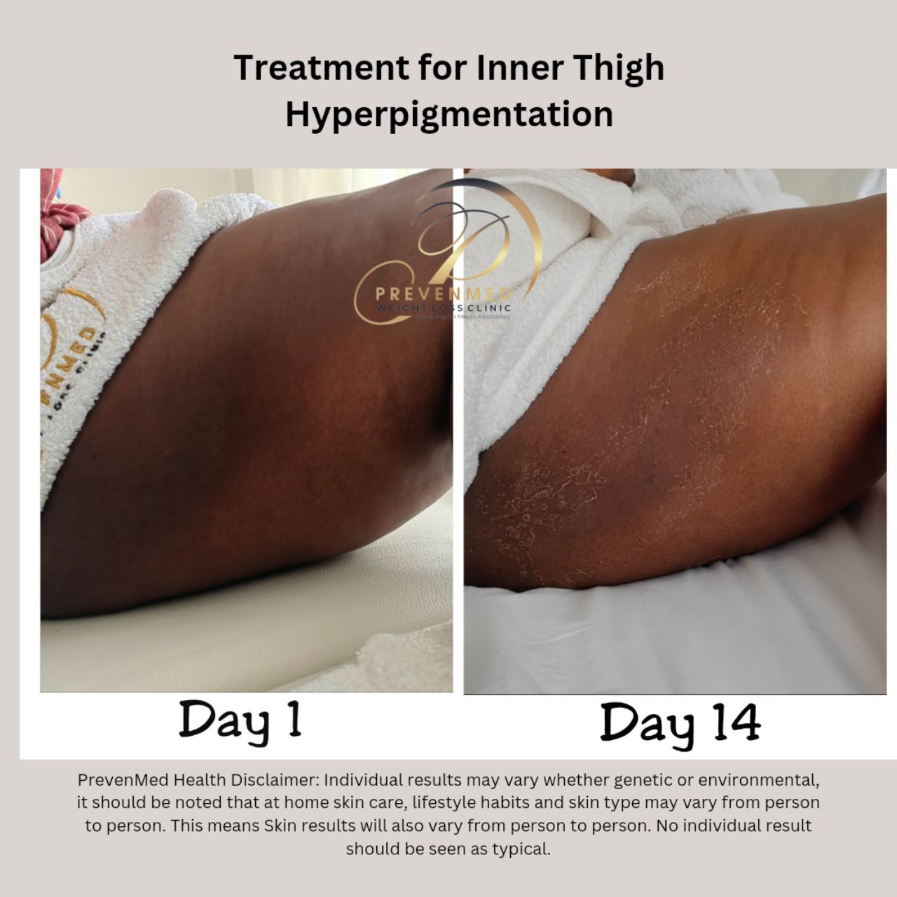 Inner Thigh Hyper pigmentation treatment