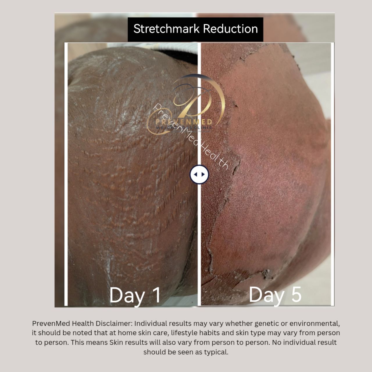 Stretchmark Reduction